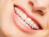 How Braces Influence Gum Health and Prevent Periodontal Disease